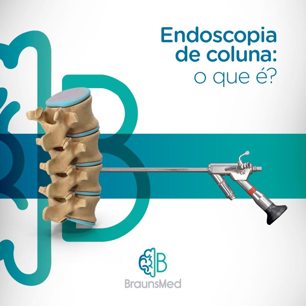 Endoscopia De Coluna O Que Braunsmed